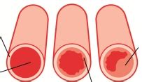 what is the impact of arteriosclerosis quizlet topic test|atherosclerosis involves a quizlet.